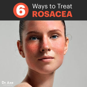 Rosacea-treatments